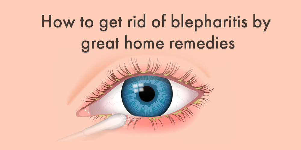 How to get rid of blepharitis by great home remedies