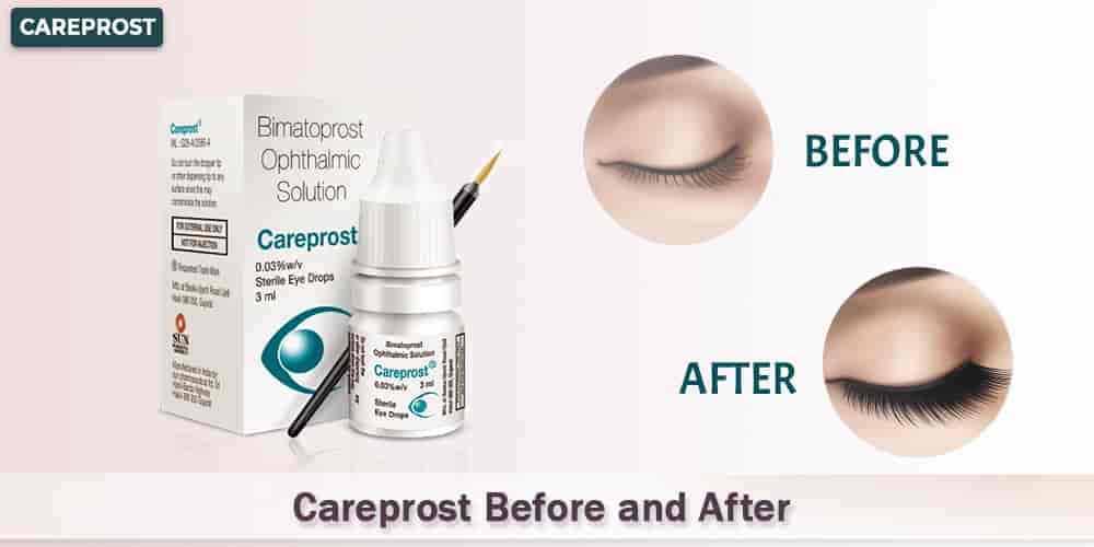 Careprost Before and After For Eyelash Growth | Careprost.co