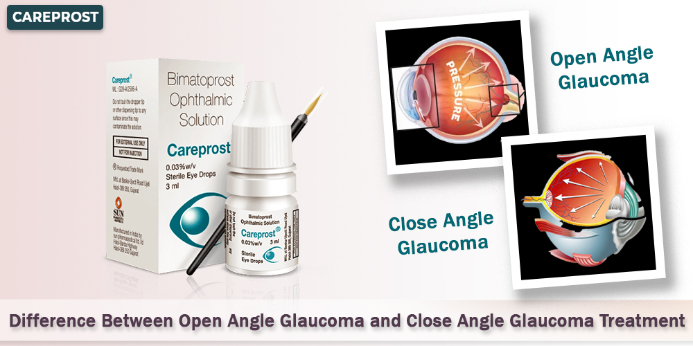 Difference Between Open Angle Glaucoma and Close Angle Glaucoma Treatment