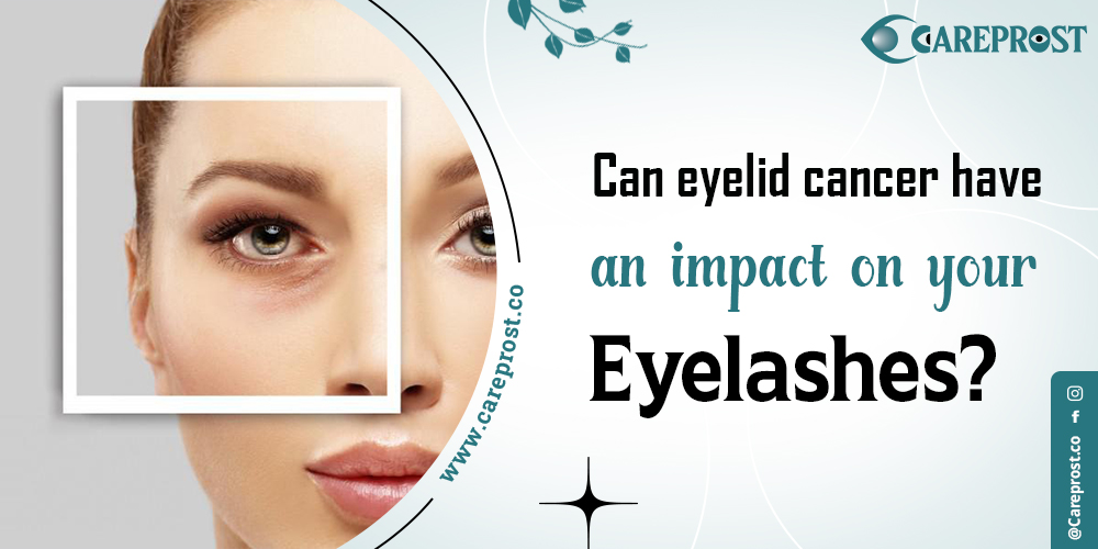 Can eyelid cancer have an impact on your eyelashes? 