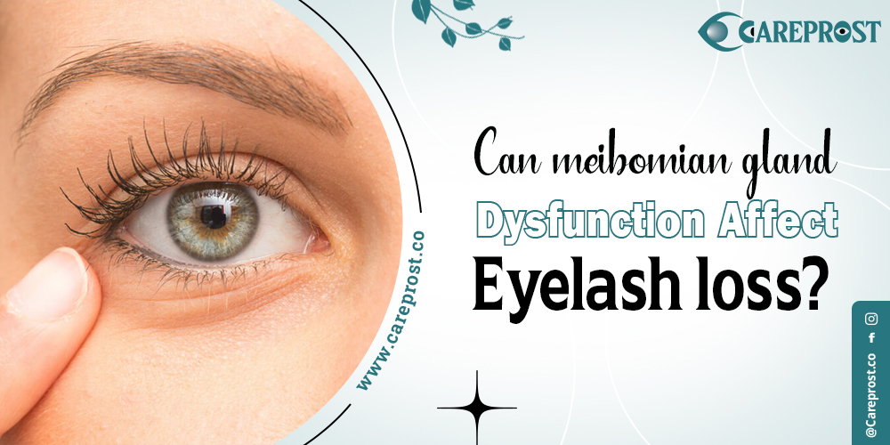 Can meibomian gland dysfunction affect eyelash loss?
